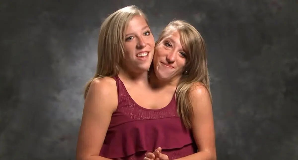 Conjoined twins Abby and Bbrittany